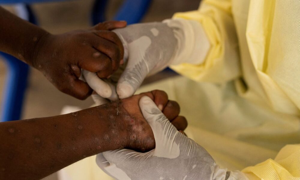 africa-declara-emergencia-em-saude-publica-por-epidemia-de-mpox